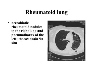 Rheumatoid lung necrobiotic rheumatoid nodules in the right lung and pneumothorax of the left; thorax drain ‘in situ   