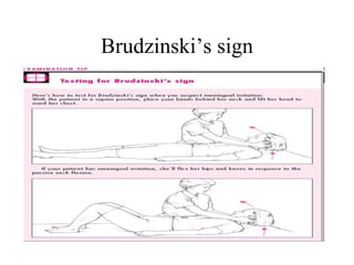 Brudzinski’s sign 