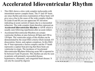 Accelerated Idioventricular Rhythm This EKG shows a slow wide complex tachycardia with intermittent narrow complex beats. The 5 th  and 10 th  beats are sinus rhythm and close examination of these beats will give you a clue to the cause of the wide complex rhythm. In Leads II and III you can appreciate ST elevation indicating an acute current of injury due to a myocardial infarction. The wide complex beats therefore represent an  Accelerated Idioventricular Rhythm  or AIVR which is usually seen following reperfusion after an acute infarct.  Accelerated Idioventricular Rhythms are ectopic ventricular rhythms at rates between 40 bpm and 100 to 120 bpm. The ventricular origin of this rhythm can be demonstrated by the usual EKG criteria which include AV dissociation, fusion, and capture complexes. In this EKG the 4 th  beat represents a fusion complex and the 5 th  beath represents a capture beat proving that these beats are ventricular in origin. The incidence of Accelerated Idioventricular Rhythms following acute MI is reported to be between 8 and 36 percent. This rhythm can also be seen in patients with primarily myocardial disease, hypertensive, rheumatic, and congenital heart disease. It can also be caused by digoxin 