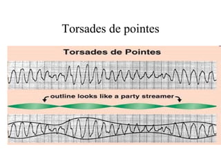 Torsades de pointes 