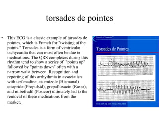 torsades de pointes This ECG is a classic example of torsades de pointes, which is French for "twisting of the points." Torsades is a form of ventricular tachycardia that can most often be due to medications. The QRS complexes during this rhythm tend to show a series of  "points up" followed by "points down" often with a narrow waist between. Recognition and reporting of this arrhythmia in association with terfenadine, astemizole (Hismanal), cisapride (Propulsid), grepafloxacin (Raxar), and mibefradil (Posicor) ultimately led to the removal of these medications from the market .  