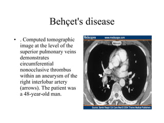 Behçet's disease . Computed tomographic image at the level of the superior pulmonary veins demonstrates circumferential nonocclusive thrombus within an aneurysm of the right interlobar artery (arrows). The patient was a 48-year-old man.  