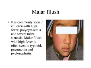 Malar fllush It is commonly seen in children with high fever, polycythaemia and severe mitral stenosis. Malar fllush with high fever is often seen in typhoid, pneumonia and pyelonephritis.  