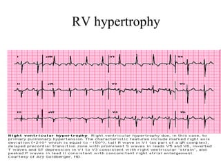 RV hypertrophy 