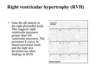 Right ventricular hypertrophy (RVH)  Note the qR pattern in the right precordial leads. This suggests right ventricular pressures greater than left ventricular pressures. The persistent S waves in lateral precordial leads and the right axis deviation are other findings in RVH.  