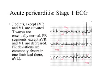 Acute pericarditis: Stage 1 ECG  J points, except aVR and V1, are elevated. T waves are essentially normal. PR segments, except aVR and V1, are depressed. PR deviations are commonly absent in one limb lead (here, aVL).  