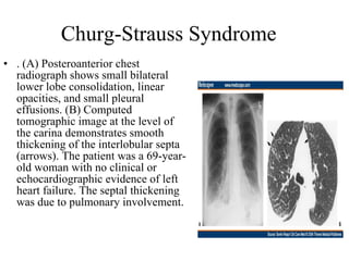 Churg-Strauss Syndrome . (A) Posteroanterior chest radiograph shows small bilateral lower lobe consolidation, linear opacities, and small pleural effusions. (B) Computed tomographic image at the level of the carina demonstrates smooth thickening of the interlobular septa (arrows). The patient was a 69-year-old woman with no clinical or echocardiographic evidence of left heart failure. The septal thickening was due to pulmonary involvement.  