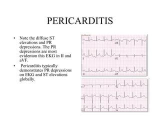 PERICARDITIS Note the diffuse ST elevations and PR depressions. The PR depressions are most evidenton this EKG in II and aVF.     Pericarditis typically demonstrates PR depressions on EKG and ST elevations globally.  
