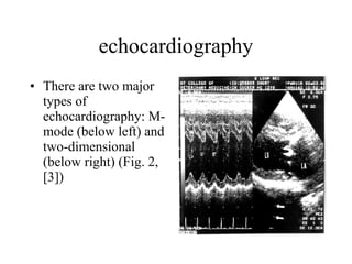 echocardiography There are two major types of echocardiography: M-mode (below left) and two-dimensional (below right) (Fig. 2, [3])  