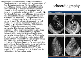 echocrdiography Examples of two-dimensional still frames obtained from hand-held echocardiographic examinations of four distinct patients.  (A)  Parasternal long axis view obtained from a patient admitted for septic shock secondary to a severe aortic endocarditis (arrows indicate vegetations) associated with a massive regurgitation and dilated left ventricle.  (B)  Parasternal short axis view obtained from a patient with an acute respiratory distress syndrome and associated cor pulmonale. The right ventricle was markedly enlarged and the ventricular septum bulged towards the left ventricular cavity at end systole, due to severe pulmonary hypertension (arrow).  (C)  Apical four-chamber view obtained from a ventilated patient with refractory hypoxemia. The contrast study (intravenous injection of saline microbubbles) revealed a large interatrial right-to-left shunt through a patent foramen ovale, which participated to persistent hypoxemia: left cardiac cavities were filled up by the microbubbles within two cardiac cycles.  (D)  Subcostal view obtained from a patient presenting with shock and pulsus paradoxus. A mild pericardial effusion responsible for prolonged right atrial collapse during the cardiac cycle (arrow) was consistent with a tamponade, and the patient underwent successful pericardotomy. LV, left ventricle; RV, right ventricle; LA, left atrium; RA, right atrium; Ao, ascending aorta.  