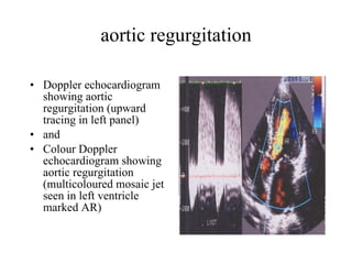 aortic regurgitation Doppler echocardiogram showing aortic regurgitation (upward tracing in left panel) and Colour Doppler echocardiogram showing aortic regurgitation (multicoloured mosaic jet seen in left ventricle marked AR) 
