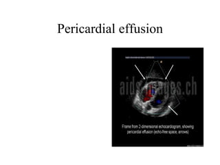 Pericardial effusion 