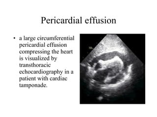 Pericardial effusion a large circumferential pericardial effusion compressing the heart is visualized by transthoracic echocardiography in a patient with cardiac tamponade.  