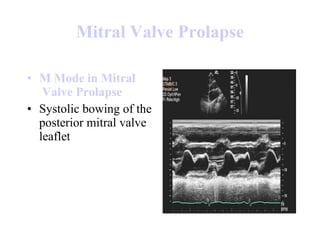 Mitral  Valve  Prolapse M Mode in  Mitral  Valve  Prolapse Systolic bowing of the posterior mitral valve leaflet  