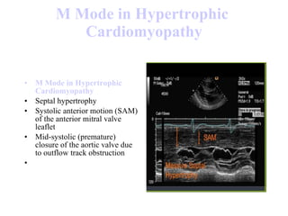 M Mode in  Hypertrophic   Cardiomyopathy M Mode in  Hypertrophic   Cardiomyopathy Septal hypertrophy  Systolic anterior motion (SAM) of the anterior mitral valve leaflet  Mid-systolic (premature) closure of the aortic valve due to outflow track obstruction  