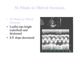 M Mode in  Mitral   Stenosis M Mode in  Mitral   Stenosis Leaflet tips bright (calcified) and thickened  E/F slope decreased  