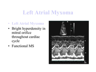 Left  Atrial   Myxoma Left  Atrial   Myxoma Bright hyperdensity in mitral orifice throughout cardiac cycle  Functional MS  