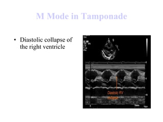 M Mode in  Tamponade Diastolic collapse of the right ventricle  