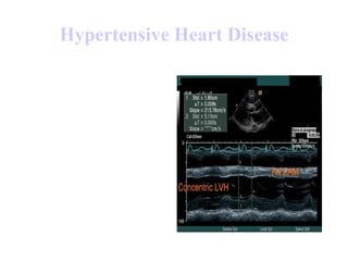 Hypertensive Heart Disease 