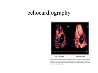 echocardiography 