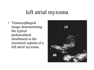 left atrial myxoma Transesophageal image demonstrating the typical pedunculated attachment to the interatrial septum of a left atrial myxoma.  