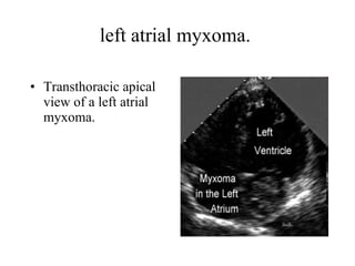 left atrial myxoma.  Transthoracic apical view of a left atrial myxoma.  