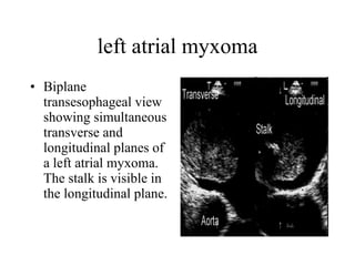 left atrial myxoma Biplane transesophageal view showing simultaneous transverse and longitudinal planes of a left atrial myxoma. The stalk is visible in the longitudinal plane.  