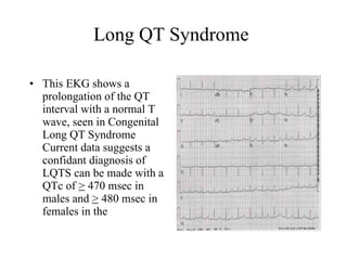 Long QT Syndrome  This EKG shows a prolongation of the QT interval with a normal T wave, seen in Congenital Long QT Syndrome Current data suggests a confidant diagnosis of LQTS can be made with a QTc of  >  470 msec in males and  >  480 msec in females in the  