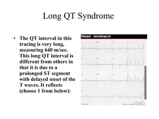 Long QT Syndrome  The QT interval in this tracing is very long, measuring 640 m/sec. This long QT interval is different from others in that it is due to a prolonged ST segment with delayed onset of the T waves. It reflects (choose 1 from below): 