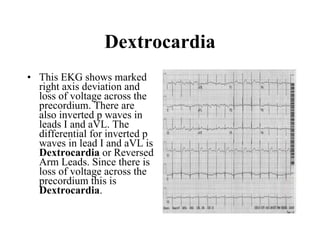 Dextrocardia This EKG shows marked right axis deviation and loss of voltage across the precordium. There are also inverted p waves in leads I and aVL. The differential for inverted p waves in lead I and aVL is  Dextrocardia  or Reversed Arm Leads. Since there is loss of voltage across the precordium this is  Dextrocardia .  