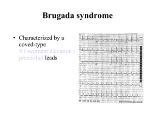 Brugada syndrome Characterized by a coved-type  ST-segment elevation in the right  precordial  leads   