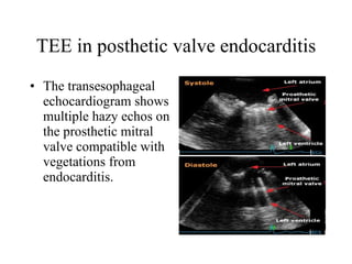 TEE in posthetic valve endocarditis The transesophageal echocardiogram shows multiple hazy echos on the prosthetic mitral valve compatible with vegetations from endocarditis.  