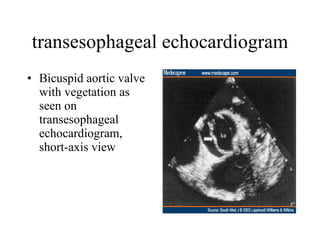 transesophageal echocardiogram Bicuspid aortic valve with vegetation as seen on transesophageal echocardiogram, short-axis view  