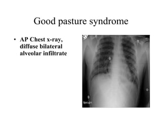 Good pasture syndrome ,[object Object]