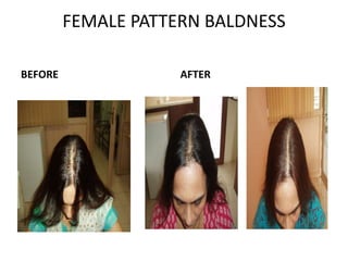 FEMALE PATTERN BALDNESS
BEFORE AFTER
 
