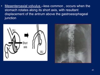 Stomach Rotation Radiology Pictures of acute abdomen.pdf