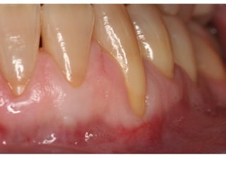 Pictures Of Connetive tissue grafting