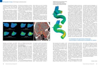 Oreillette gauche d’un cœur humain présentant 4 niveaux
                                            Demographic Change | Technologies cardiovasculaires
                                                                                                                                                                                                      cicatriciels, cause majeure d’arythmie. À gauche
                                                                                                                                                                                                      et ci-dessous : anévrisme cérébral. Les risques peuvent
                                                                                                                                                                                                      être déterminés grâce aux simulations du flux sanguin.
                                            aux patients le traumatisme d’une chirurgie et     recouvrement des extrémités des coronaires,         devrait doubler au cours des 10 prochaines                                                                   Corporate Research, à Baltimore. Siemens étu-       La sensibilité croissante de l’angiographie — le
                                            limite sensiblement les coûts associés. Déjà       ce qui provoquerait immédiatement une crise         années. Cette tendance alarmante a incité                                                                    die également un logiciel de navigation dédié       tout dernier système pouvant identifier des
                                            introduite en Europe, cette technologie            cardiaque. » Une fois la valve en position, un      Siemens à travailler avec SurgiVision, un fabri-                                                             à la visualisation des cathéters et du cœur         structures de seulement 150 microns — favorise
                                            devrait s’étendre aux États-Unis dans un proche    ballon situé à l’intérieur du cathéter se déploie   cant d’équipements médicaux de Memphis, et                                                                   en 3D – une technologie clé au service de la        leur détection, mais il n’est pas possible de
                                            avenir.                                            (Cf. illustration, page précédente) afin d’ouvrir   l’école de médecine de l’université de l’Utah                                                                précision du positionnement des cathéters et        déterminer visuellement leur dangerosité.
                                                Cette nouvelle procédure, au stade de          la prothèse et de la comprimer fermement            au développement d’une procédure peu inva-                                                                   de l’ablation des tissus par le cardiologue.        D’où l’utilité de la MFN. L’équipe Siemens de
                                            prototype, se base sur le système d’angiogra-      contre la paroi aortique.                           sive permettant aux cardiologues de visualiser                                                                   Ces avancées technologiques imposent            Princeton – Bogdan Georgescu, Viorel Mihalef
                                            phie cardiaque 3D DynaCT de Siemens.                   À ce jour, la procédure a été réalisée sur      et d’éliminer les tissus fibreux de manière très                                                             naturellement le développement de cathéters         et Puneet Sharma – est parvenue à modéliser
                                            Normalement utilisées pour les procédures          plus de 150 patients d’une moyenne d’âge de         précise au moyen d’un cathéter introduit dans                                                                d’ablation et de cartographie compatibles           les anévrismes en 3D à partir d’images haute
                                            interventionnelles, telles que la mise en place    78 ans, en Europe. Le Dr Rüdiger Lange,             le cœur via une minuscule incision et guidé                                                                  avec les puissants champs magnétiques de            résolution afin de les soumettre à un algo-
                                            d’un stent dans une artère obstruée, les radio-    Directeur du centre cardiologique de Munich         par IRM en temps réel.                                                                                       l’IRM et capables d’interagir avec les signaux et   rithme simulant le flux sanguin. « Les études
                                            graphies DynaCT fournissent des images             est l’un des rares chirurgiens rompus à cette           Cette procédure, toujours à l’étude, devrait                                                             le logiciel d’un scanner pour assurer un suivi et   préliminaires indiquent que la probabilité de
                                            extrêmement détaillées du thorax. Lors de l’im-    pratique : « L’avantage majeur de ce nouveau        présenter des atouts de taille par rapport aux                                                               une visualisation en temps réel. SurgiVision a      rupture dépend de facteurs tels que les fluc-
                                            plantation d’une valve aortique, le chirurgien a   logiciel est qu’il procure une visualisation        techniques d’ablation existantes. Ces dernières,                                                             ainsi mis au point une gamme de cathéters           tuations de la pression et du flux sanguins
                                            principalement besoin de visualiser la racine      claire de l’angle de la prothèse. Il s’agit d’un    qui exploitent également des cathéters, utili-                                                               dotés d’antennes de transmission miniatures.        dans la mesure où ils sont liés aux caractéris-
                                            aortique. Les chercheurs de Siemens ont donc       aspect vital car la valve aortique est parfois      sent en effet la radiographie, impliquant                                                                    « Les signaux émis par l’antenne des cathéters      tiques des parois des vaisseaux », explique
                                                                                                                                                                                                                                                                sont détectés par les séquences d’impulsions        Bogdan Georgescu. « C’est un progrès impor-
                                                                                                                                                                                                                                                                du scanner dans lequel le patient est allongé,      tant vers l’éventuelle personnalisation du
                                                                                                                                                                                                                                                                indiquant en temps réel leur position et leur       traitement », ajoute Thomas Redel.
                                                                                                                                                                                                                                                                orientation en trois dimensions », explique             Les chercheurs de Siemens simulent diffé-
                                                                                                                                                                                                                                                                Kimble Jenkins, Directeur de SurgiVision. « Le      rentes combinaisons de paramètres pour
                                                                                                                                                                                                                                                                cardiologue peut donc voir l’emplacement            essayer de comprendre ce qui déclenche – et
                                                                                                                                                                                                                                                                exact des cathéters ainsi que des images            ce qui empêche – la rupture d’un anévrisme.
                                                                                                                                                                                                                                                                haute résolution de l’anatomie cardiaque du         Ils testent dans cette optique les effets des
                                                                                                                                                                                                                                                                patient dans le même espace 3D, qui devient         stents de type « flow diverters ». Contraire-
                                                                                                                                                                                                                                                                par conséquent l’espace chirurgical. »              ment au traitement conventionnel de l’ané-
                                                                                                                                                                                                                                                                Lumière sur les risques d’anévrisme.                vrisme par clippage de son collet, pouvant
                                                                                                                                                                                                                                                                Les chercheurs de Siemens s’intéressent à la        entraîner une perforation dangereuse, ces
                                                                                                                                                                                                                                                                mécanique des fluides numérique (MFN), un           stents redirigent simplement une partie du
© University of Utah/Dr. Nassir Marrouche




                                                                                                                                                                                                                                                                outil industriel éprouvé, et à ses possibles        sang vers d’autres vaisseaux. « Nous sommes
                                                                                                                                                                                                                                                                applications dans le domaine médical, notam-        convaincus que la MFN a un rôle important à
                                                                                                                                                                                                                                                                ment concernant les anévrismes, des sortes          jouer », confirme le Dr Jan Boese. « Avant l’in-
                                                                                                                                                                                                                                                                de poches qui se forment sur les parois             tervention, le médecin pourrait ainsi exécuter
                                                                                                                                                                                                                                                                artérielles. Une rupture d’anévrisme dans le        des simulations pour optimiser la mise en


                                                                                                                                                                                                                                                                   Les simulations des anévrismes révèlent des
                                                                                                                                                                                                                                                                   caractéristiques conditionnant la probabilité de rupture.

                                            développé une technologie « qui identifie          vrillée, ce qui implique des risques d’erreur.      une exposition du patient et du chirurgien à       état trop avancé pour une ablation. « Avec                cerveau peut entraîner un décès ou un handi-        place du stent. » En Allemagne et aux États-
                                            automatiquement la zone valvulaire dans un         Cette technique affiche de plus une précision       de puissants rayons X pendant plus de              cette méthodologie, les cardiologues dispo-               cap. Un tiers seulement des patients en ayant       Unis, les équipes Siemens développent à cette
                                            ensemble de données DynaCT et élimine              des plus appréciables. »                            4 heures, pour un résultat peu concluant en        sent d’un outil décisionnel plus performant               subi une s’en remettent totalement. Les ex-         fin une plateforme logicielle qui permettra
                                            toutes les informations superflues de l’image,     Au cœur de l’imagerie. C’est là un parfait          termes de visualisation et de précision, et un     pour déterminer s’il est utile de traiter un pa-          perts estiment que 1 à 5 % de la population         aux praticiens de valider ces simulations
                                            telles que la cage thoracique », explique le       exemple des maladies liées à la vieillesse.         taux de réussite de seulement 50 à 75 %.           tient. Ils peuvent ainsi exclure en toute                 présentent un anévrisme (cette proportion           par rapport aux mesures effectuées sur les
                                            Dr Jan Boese, responsable des innovations et       Tout comme la carrosserie d’un véhicule             « Notre guidage par résonance magnétique           confiance les patients sur lesquels la procé-             augmentant avec l’âge). Néanmoins, la rupture       patients.
                                            du prototypage au sein de l’entité opération-      s’abîme et perd de son lustre au fil des ans,       améliorera significativement la qualité de l’in-   dure n’aurait aucun effet bénéfique », indique            ne concerne qu’une minorité de cas. Selon               Les chercheurs espèrent que l’identifica-
                                            nelle Angiography de Siemens Healthcare.           notre cœur finit souvent par accumuler des          tervention tout en réduisant sa durée »,           Walter Märzendorfer.                                      le Dr Thomas Redel, spécialiste en systèmes         tion des risques hémodynamiques potentiels
                                                À mesure que la nouvelle valve insérée         tissus cicatriciels fibreux, pour des raisons qui   affirme Walter Märzendorfer, CEO de l’entité          La nouvelle technique IRM d’ablation a en-             d’angiographie chez Siemens Healthcare, « la        via la MFN favorisera à terme la prédiction des
                                            dans la pointe du cathéter se rapproche de la      nous échappent encore. Ces tissus peuvent           Magnetic Resonance de Siemens Healthcare.          registré des progrès notables sur les animaux,            question est de savoir comment le médecin           crises cardiaques et l’optimisation des traite-
                                            zone d’intérêt, le logiciel détermine son angu-    engendrer des anomalies de l’activité élec-             Les recherches conjointes, sous la direction   mais des travaux complémentaires sont                     peut évaluer le risque de rupture s’il découvre     ments, notamment en termes de sélection et
                                            lation optimale. « C’est la clé de la procé-       trique appelées arythmies ; 60 % d’entre elles      du Dr Nassir F. Marrouche, Directeur du            encore nécessaires avant les essais cliniques.            un anévrisme lors d’une angiographie ou IRM         de mise en place de prothèses valvulaires
                                            dure », commente le Dr Rui Liao, de SCR, qui a     se développent au niveau des fines parois           Comprehensive Arrhythmia Research &                « Nous travaillons, avec l’équipe universitaire           de routine ». La réponse pourrait avoir des         mitrales et aortiques, d’administration locali-
                                            développé le logiciel avec le Dr Yefeng Zheng.     internes de l’oreillette gauche, provoquant un      Management Center de l’université de l’Utah,       de l’Utah et SurgiVision, à l’affinement des              conséquences économiques considérables              sée de substances thérapeutiques ou encore
                                            « Il détecte automatiquement les repères ana-      état souvent asymptomatique de fibrillation         à Salt Lake City, ont déjà donné naissance à un    séquences d’impulsions de nos scanners en                 puisque le traitement des anévrismes se chif-       de formation des futurs médecins.
                                            tomiques de la région valvulaire aortique et       auriculaire (FA), principale cause d’AVC et         système d’évaluation pré-traitement basé           vue d’une acquisition IRM et d’un suivi du                fre à environ 1,8 milliard de dollars à l’échelle
                                            offre une confirmation visuelle de l’angle         d’insuffisance cardiaque chez les personnes         sur la résonance magnétique (Cf. illustration      cathéter en temps réel continus », précise                mondiale.
                                            précis de la prothèse. Ces informations sont       de 65 ans et plus.                                  de gauche, ci-dessus) regroupant les patients      Christine H. Lorenz, Directrice du centre d’ima-              Les anévrismes, dont la taille et la forme
                                            cruciales pour un positionnement correct sur           Au vu du prolongement de l’espérance de         FA dans l’une des 4 catégories définies, du        gerie médicale appliquée réunissant des                   varient, sont généralement localisés au niveau
                                            l’ancienne valve sans risque de fuite ou de        vie, la prévalence de la fibrillation auriculaire   stade 1 – excellent pronostic – au stade 4 –       équipes de Siemens Healthcare et Siemens                  du cerveau, de l’abdomen ou de l’aorte.                                             Arthur F. Pease


                                            30       Pictures of the Future | Printemps 2011                                                                                                                                                                                                                        Pictures of the Future | Printemps 2011      31
 