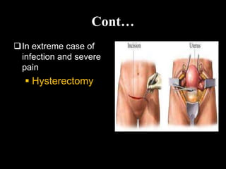 Cont…
In extreme case of
infection and severe
pain
 Hysterectomy
 