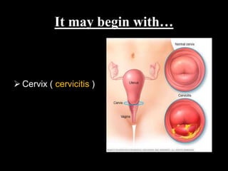 It may begin with…
 Cervix ( cervicitis )
 