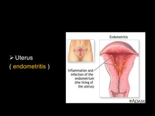  Uterus
( endometritis )
 