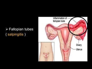  Fallopian tubes
( salpingitis )
 