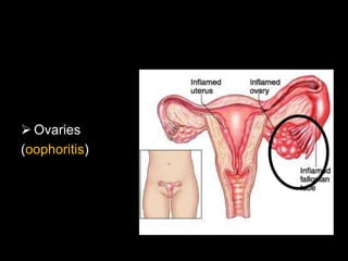  Ovaries
(oophoritis)
 