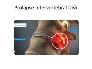 Prolapse Intervertebral Disk
 