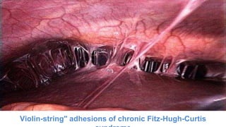 Violin-string" adhesions of chronic Fitz-Hugh-Curtis
 