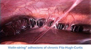 Violin-string" adhesions of chronic Fitz-Hugh-Curtis
 