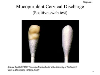 Mucopurulent Cervical Discharge
(Positive swab test)
14
Source:Seattle STD/HIV Prevention Training Center at the University of Washington/
Claire E. Stevens and Ronald E. Roddy
Diagnosis
 
