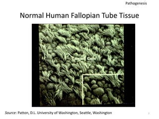 Normal Human Fallopian Tube Tissue
7
Source: Patton, D.L. University of Washington, Seattle, Washington
Pathogenesis
 
