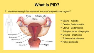 What is PID?
• Infection causing inflammation of a woman’s reproductive organs*1
• Vagina - Colpitis
• Cervix - Endocervicitis
• Uterus - Endometritis
• Fallopian tubes - Salpingitis
• Ovaries - Oophoritis
• Tubo-ovarian abscess
• Pelvic peritonitis
 