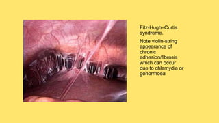 Fitz-Hugh–Curtis
syndrome.
Note violin-string
appearance of
chronic
adhesion/fibrosis
which can occur
due to chlamydia or
gonorrhoea
 